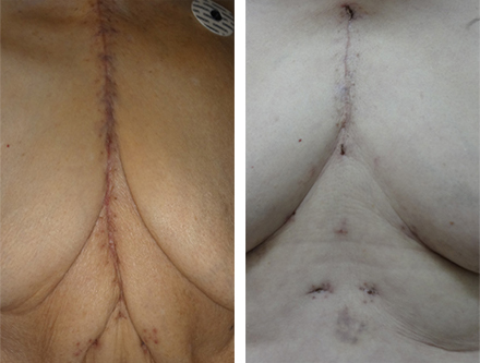 左が従来の胸骨正中切開後の創部、右がMICS-TAR手術後の創部